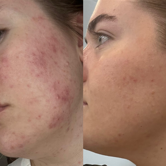 Before and after images clearing acne effectively