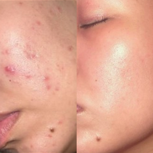 Rapid Clear Acne Wipes