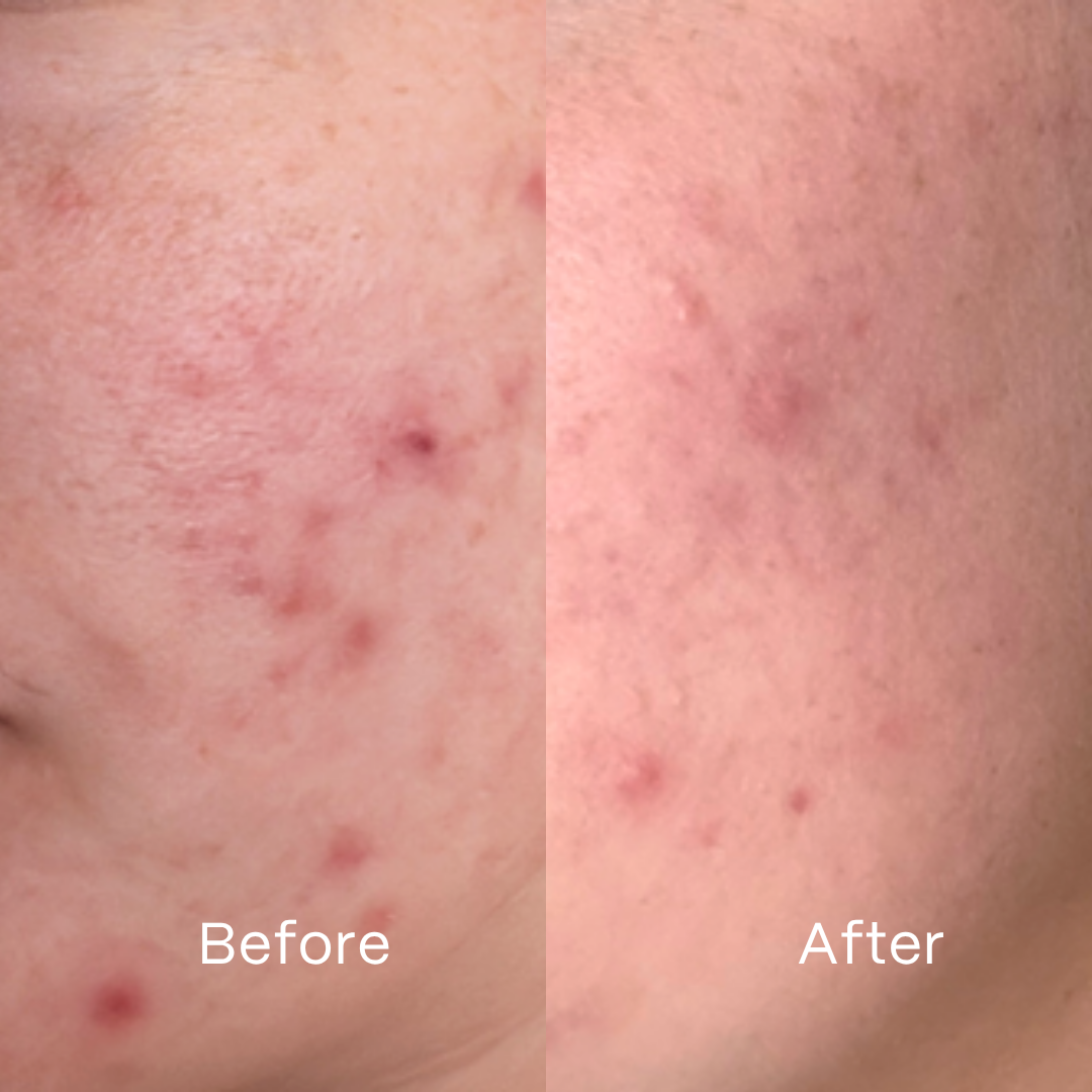 Complete Clear Skin Microbiome System