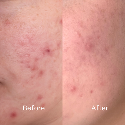 Complete Clear Skin Microbiome System