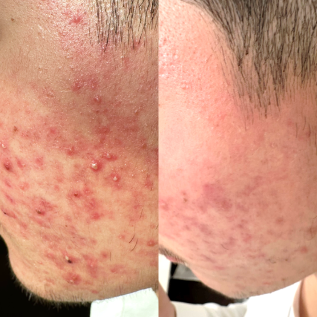 UltraClear Acne Skincare Bundle - High-Strength Cleanser and Serum for Stubborn Acne