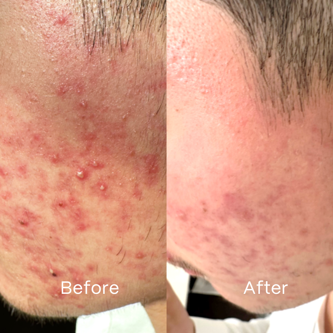 UltraClear Acne Kit