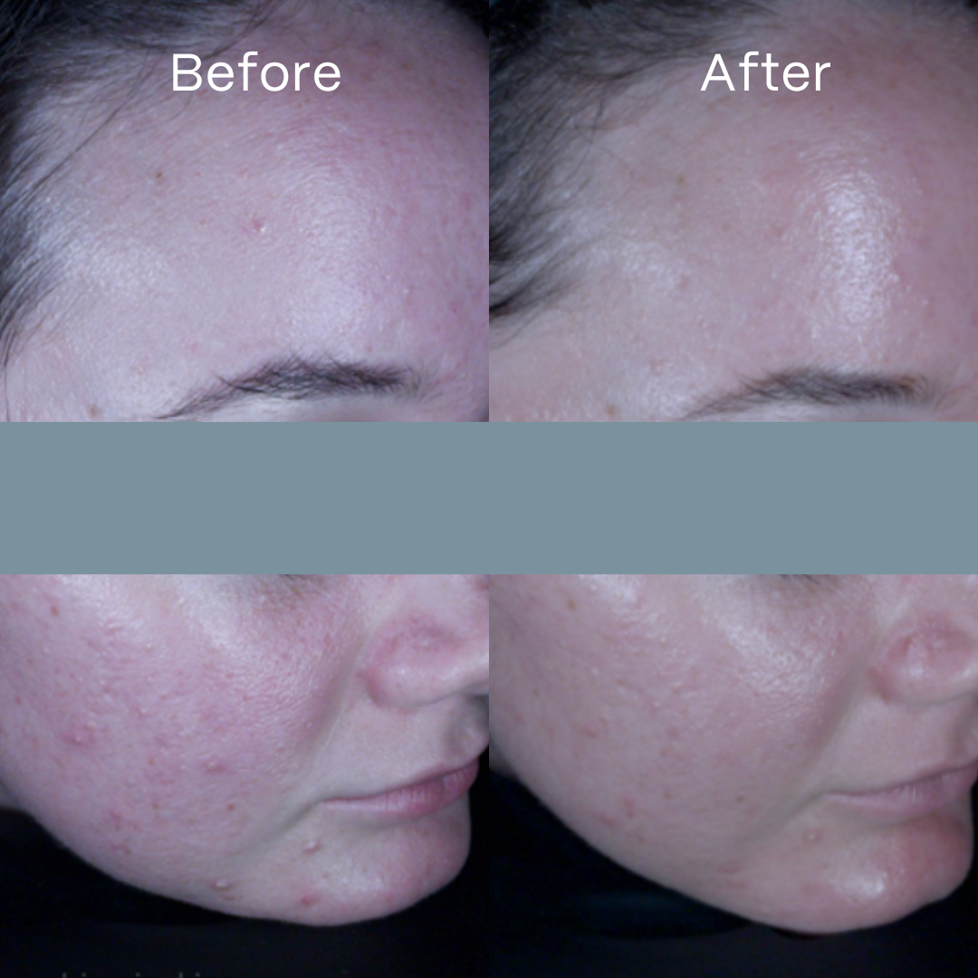 UltraClear Hydrogel Mask 4 Pack