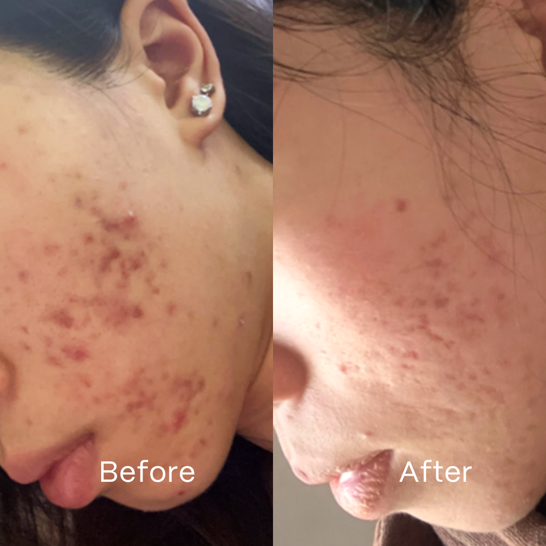 UltraClear Acne Kit