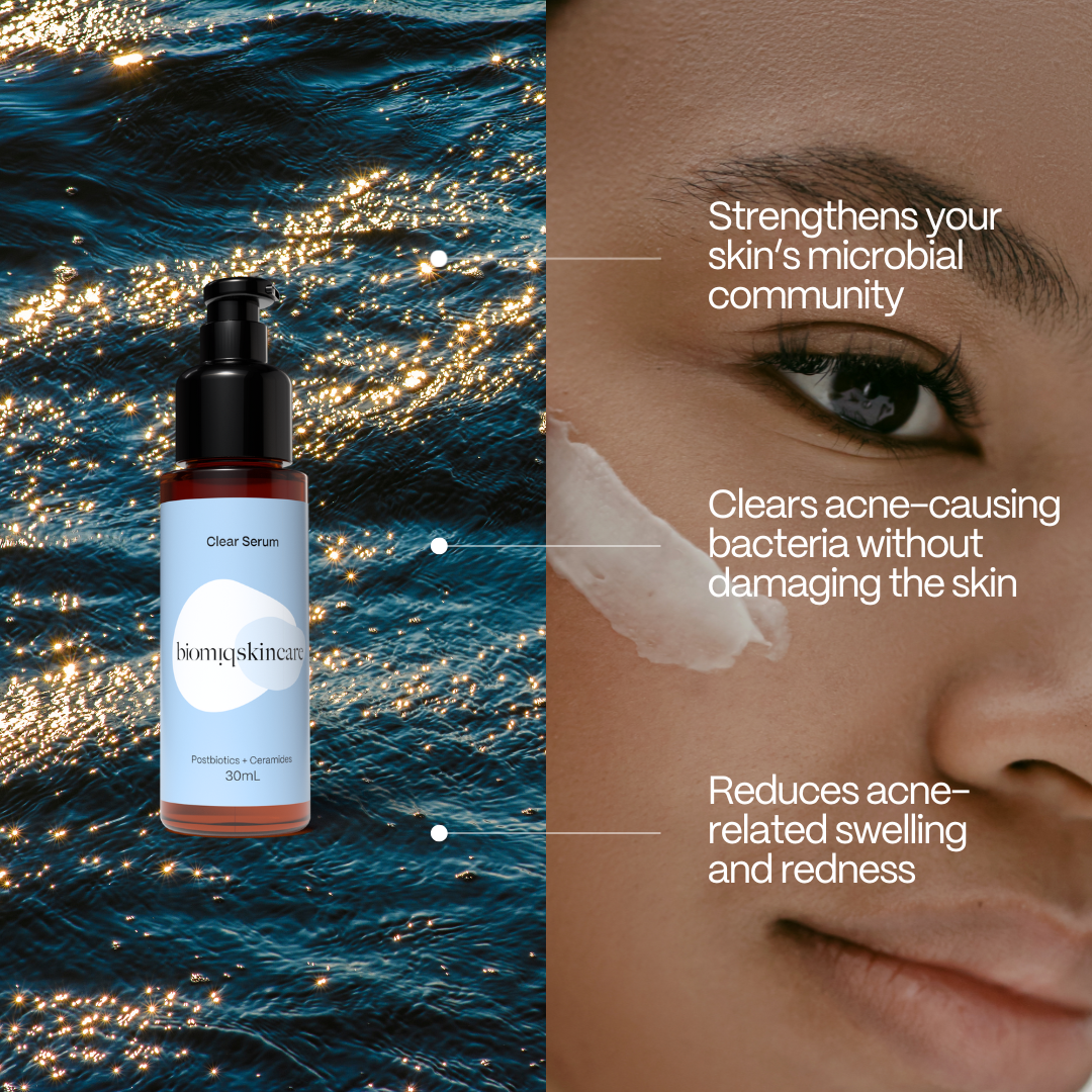 Clear Complexion Acne Serum - Targeted Acne Solution